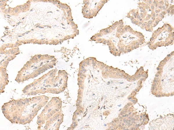 Immunohistochemistry of paraffin-embedded Human thyroid cancer tissue  using DCD Polyclonal Antibody at dilution of 1:35(?200)