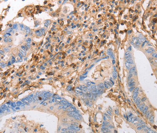 Immunohistochemistry of paraffin-embedded Human colon cancer using INA Polyclonal Antibody at dilution of 1:50