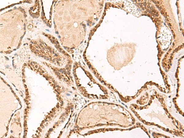 Immunohistochemistry of paraffin-embedded Human thyroid cancer tissue  using FUNDC2 Polyclonal Antibody at dilution of 1:50(?200)