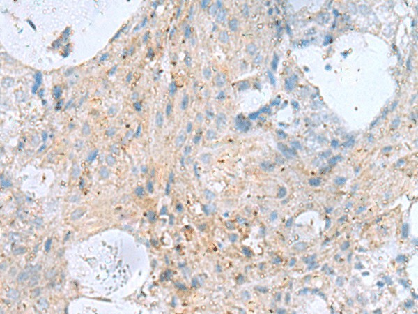 Immunohistochemistry of paraffin-embedded Human ovarian cancer tissue  using KIF5A Polyclonal Antibody at dilution of 1:30(?200)