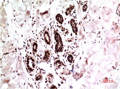 Immunohistochemistry of paraffin-embedded Human breast carcinoma tissue using ERK 1 Monoclonal Antibody at dilution of 1:200.