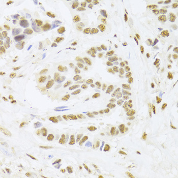 Immunohistochemistry of paraffin-embedded human breast cancer using ANP32A Polyclonal antibody at dilution of 1:100 (40x lens).Perform microwave antigen retrieval with 10 mM PBS buffer pH 7.2 before commencing with IHC staining protocol.