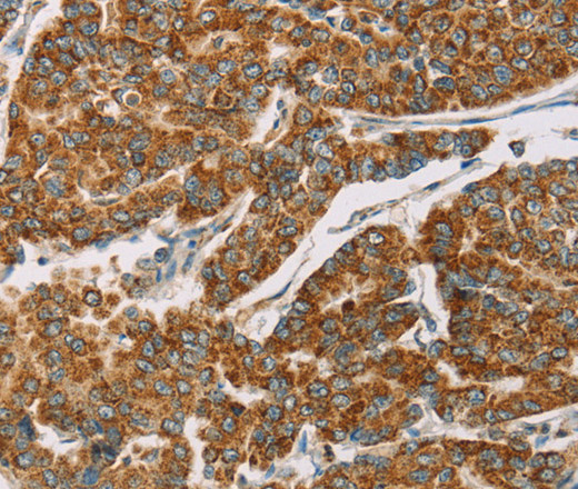 Immunohistochemistry of paraffin-embedded Human breast cancer tissue using DLL4 Polyclonal Antibody at dilution 1:40