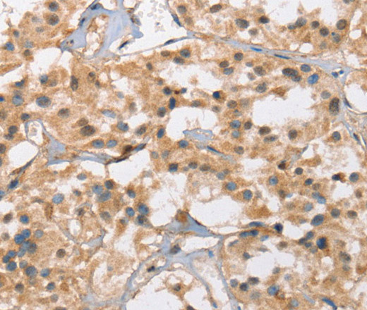 Immunohistochemistry of paraffin-embedded Human thyroid cancer tissue using Cav1.3 Polyclonal Antibody at dilution 1:40