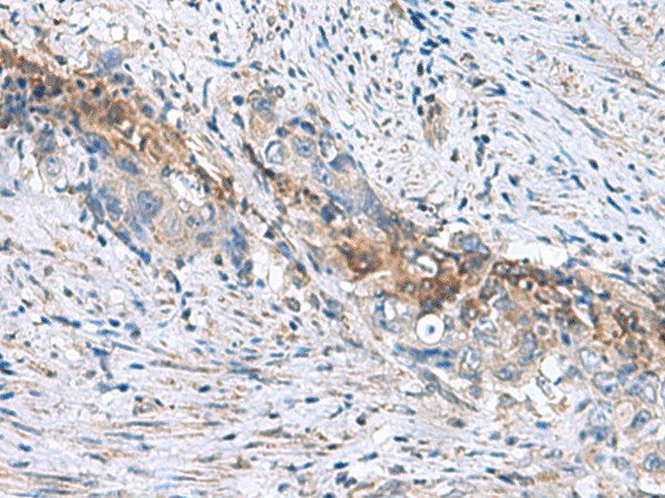 Immunohistochemistry of paraffin-embedded Human cervical cancer tissue  using RNF208 Polyclonal Antibody at dilution of 1:55(?200)