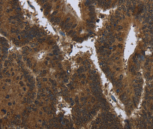 Immunohistochemistry of paraffin-embedded Human colon cancer tissue using PIP Polyclonal Antibody at dilution 1:50