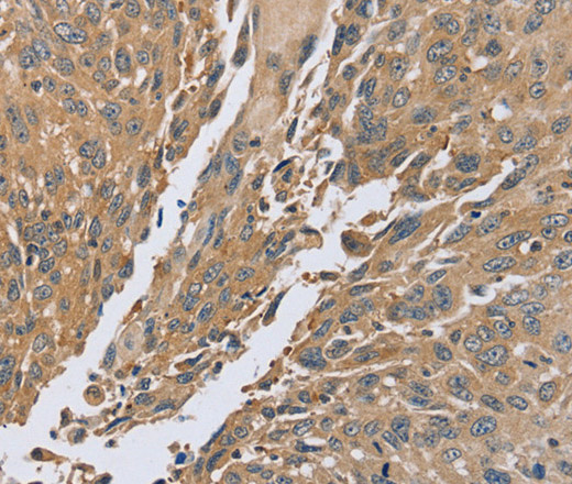 Immunohistochemistry of paraffin-embedded Human lung cancer using PTPN12 Polyclonal Antibody at dilution of 1:45