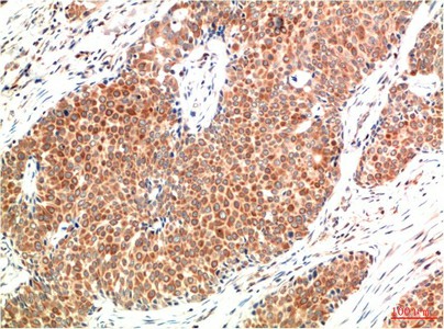 Immunohistochemistry of paraffin-embedded Human breast carcinoma tissue using ATM Monoclonal Antibody at dilution of 1:200.