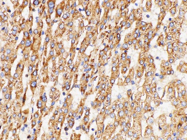 Immunohistochemistry of paraffin-embedded Human liver cancer using GPNMB Polycloanl Antibody at dilution of 1:200.