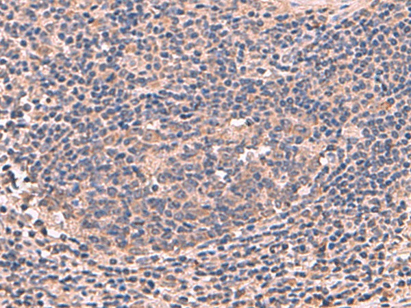 Immunohistochemistry of paraffin-embedded Human cervical cancer tissue  using MAGEC2 Polyclonal Antibody at dilution of 1:60(?200)