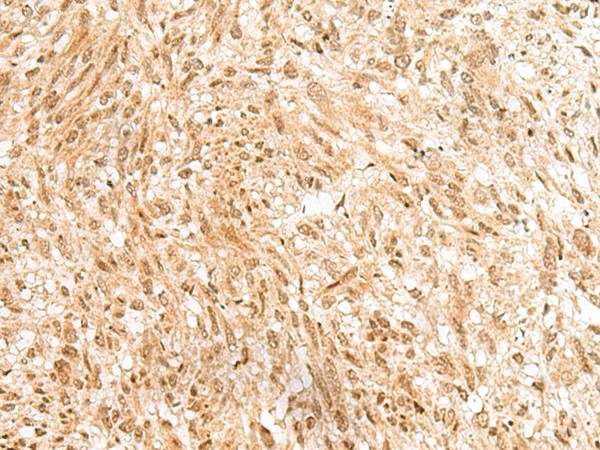 Immunohistochemistry of paraffin-embedded Human liver cancer tissue  using RBM19 Polyclonal Antibody at dilution of 1:45(?200)