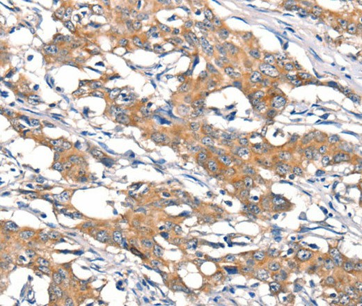 Immunohistochemistry of paraffin-embedded Human gasrtic cancer tissue using DSC1 Polyclonal Antibody at dilution 1:40