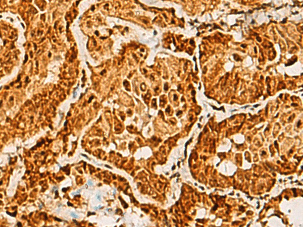 Immunohistochemistry of paraffin-embedded Human thyroid cancer tissue  using SAP30BP Polyclonal Antibody at dilution of 1:40(?200)