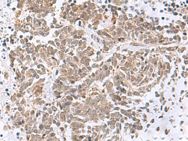 Immunohistochemistry of paraffin-embedded Human lung cancer tissue  using RBFOX2 Polyclonal Antibody at dilution of 1:50(?200)