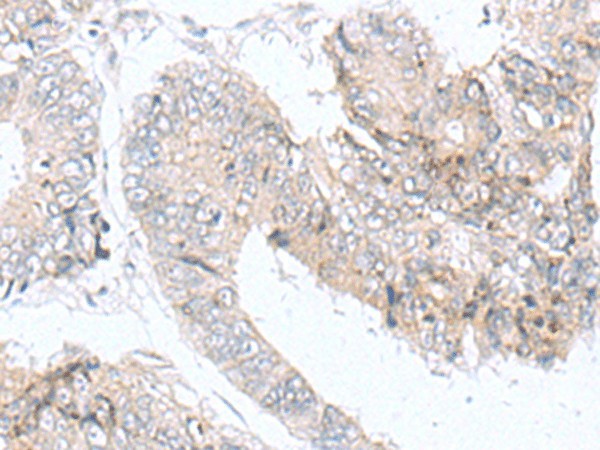 Immunohistochemistry of paraffin-embedded Human colorectal cancer tissue  using IQCD Polyclonal Antibody at dilution of 1:90(?200)