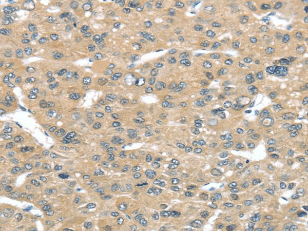 Immunohistochemistry of paraffin-embedded Human liver cancer tissue using TUSC2 Polyclonal Antibody at dilution 1:50