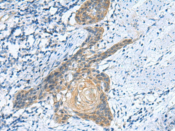 Immunohistochemistry of paraffin-embedded Human esophagus cancer tissue  using GINS3 Polyclonal Antibody at dilution of 1:50(?200)