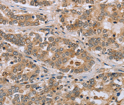 Immunohistochemistry of paraffin-embedded Human liver cancer tissue using CLEC16A Polyclonal Antibody at dilution 1:45