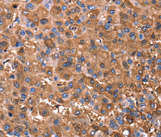 Immunohistochemistry of paraffin-embedded Human liver cancer tissue using ERN2 Polyclonal Antibody at dilution 1:40