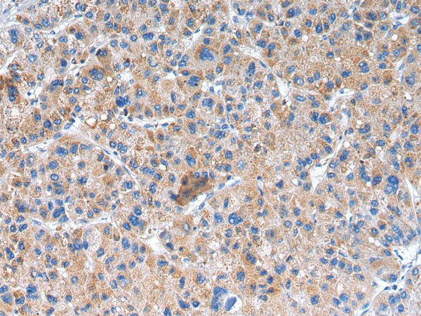 Immunohistochemistry of paraffin-embedded Human liver cancer using GLRA1 Polyclonal Antibody at dilution of  1/20