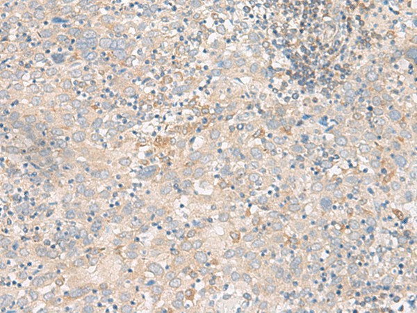 Immunohistochemistry of paraffin-embedded Human cervical cancer tissue  using FGF13 Polyclonal Antibody at dilution of 1:45(?200)