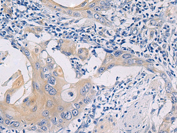 Immunohistochemistry of paraffin-embedded Human esophagus cancer tissue  using GALR3 Polyclonal Antibody at dilution of 1:50(?200)