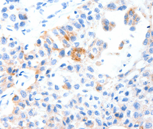 Immunohistochemistry of paraffin-embedded Human lung cancer tissue using MUC3A Polyclonal Antibody at dilution 1:60