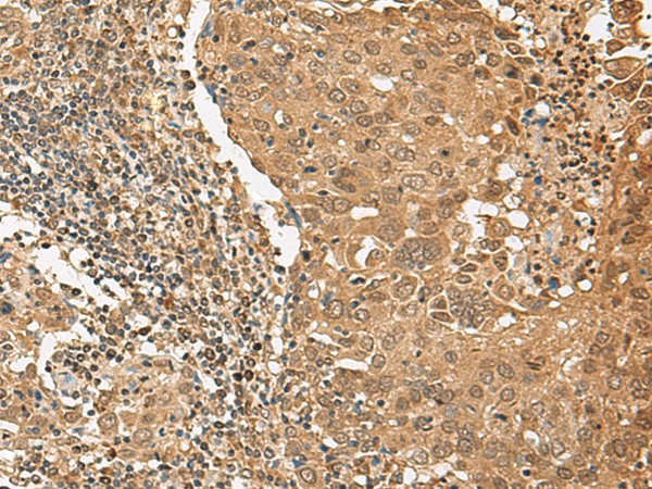 Immunohistochemistry of paraffin-embedded Human cervical cancer tissue  using TIPRL Polyclonal Antibody at dilution of 1:65(?200)