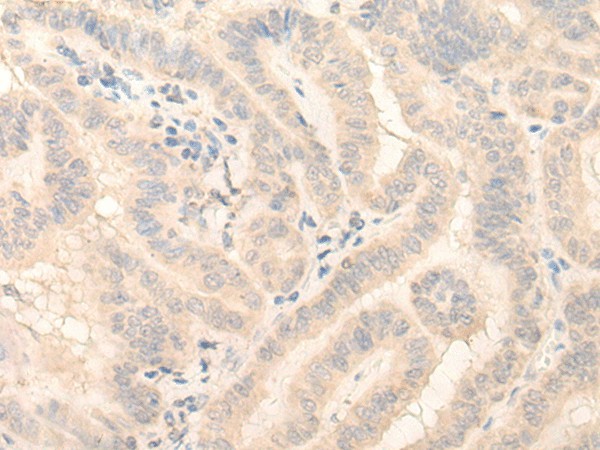 Immunohistochemistry of paraffin-embedded Human thyroid cancer tissue  using HMBS Polyclonal Antibody at dilution of 1:25(?200)