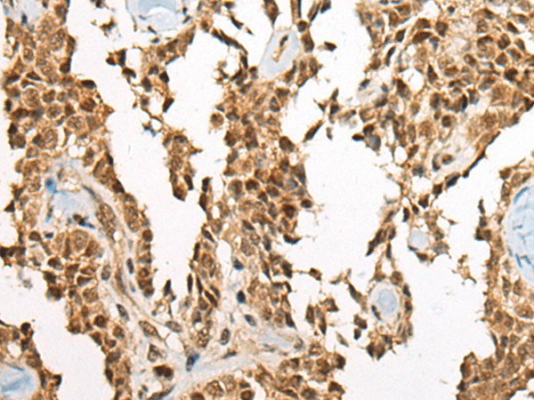 Immunohistochemistry of paraffin-embedded Human ovarian cancer tissue  using ATE1 Polyclonal Antibody at dilution of 1:60(?200)