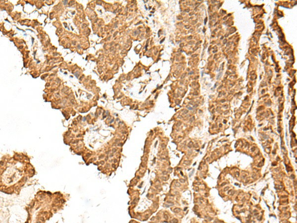 Immunohistochemistry of paraffin-embedded Human thyroid cancer tissue  using VPS50 Polyclonal Antibody at dilution of 1:45(?200)