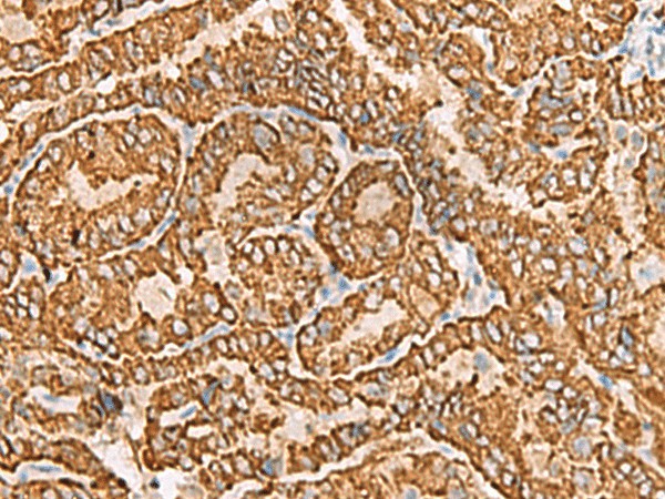 Immunohistochemistry of paraffin-embedded Human thyroid cancer tissue  using NPC2 Polyclonal Antibody at dilution of 1:80(?200)