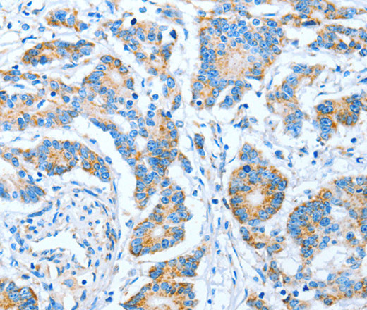 Immunohistochemistry of paraffin-embedded Human colon cancer using IMMT Polyclonal Antibody at dilution of 1:70