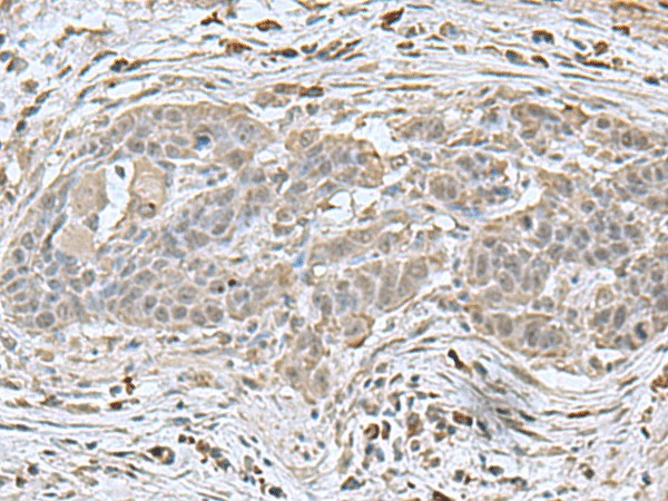 Immunohistochemistry of paraffin-embedded Human esophagus cancer tissue  using NEUROG3 Polyclonal Antibody at dilution of 1:70(?200)