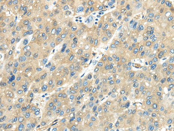 Immunohistochemistry of paraffin-embedded Human liver cancer tissue using VPS4A Polyclonal Antibody at dilution 1:40