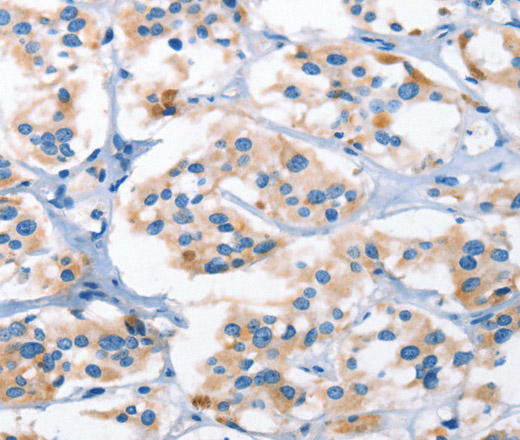 Immunohistochemistry of paraffin-embedded Human thyroid cancer tissue using AHR Polyclonal Antibody at dilution 1:50