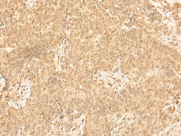 Immunohistochemistry of paraffin-embedded Human ovarian cancer tissue  using ST8SIA4 Polyclonal Antibody at dilution of 1:50(?200)