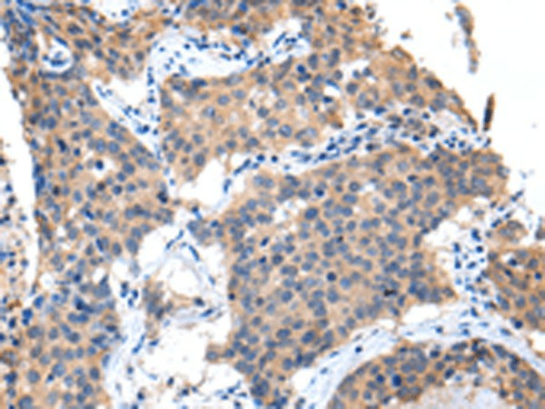 Immunohistochemistry of paraffin-embedded Human lung cancer tissue  using PPBP Polyclonal Antibody at dilution of 1:35(?200)