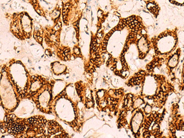 Immunohistochemistry of paraffin-embedded Human thyroid cancer tissue  using EPCAM Polyclonal Antibody at dilution of 1:40(?200)