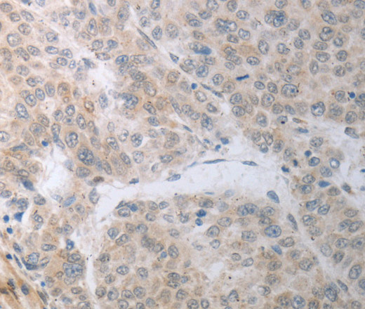 Immunohistochemistry of paraffin-embedded Human liver cancer using RBMS3 Polyclonal Antibody at dilution of 1:70