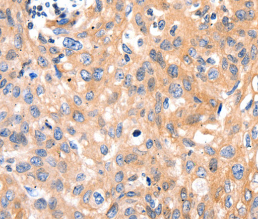 Immunohistochemistry of paraffin-embedded Human cervical cancer using MYL9 Polyclonal Antibody at dilution of 1:80