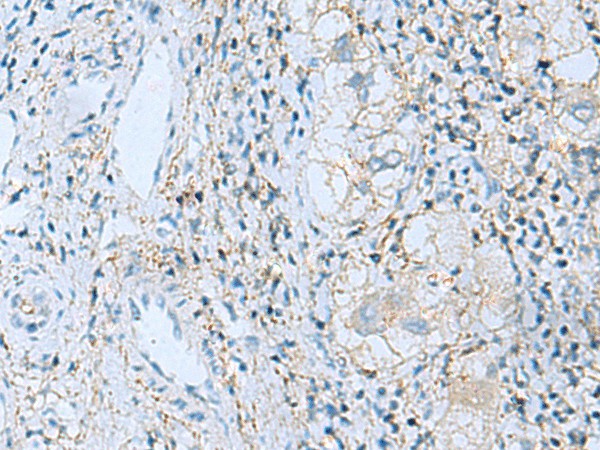 Immunohistochemistry of paraffin-embedded Human liver cancer tissue  using EMILIN1 Polyclonal Antibody at dilution of 1:55(?200)