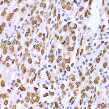 Immunohistochemistry of paraffin-embedded Human gastric cancer using Lamin A/C Polyclonal Antibody at dilution of  1:100 (40x lens).