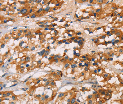 Immunohistochemistry of paraffin-embedded Human thyroid cancer tissue using CD80 Polyclonal Antibody at dilution 1:50