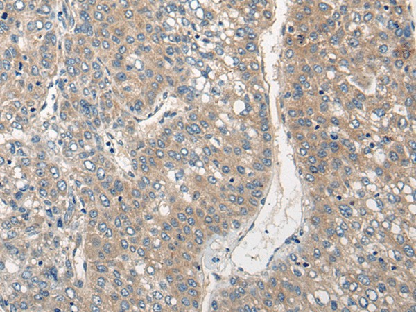 Immunohistochemistry of paraffin-embedded Human liver cancer tissue  using CLIC6 Polyclonal Antibody at dilution of 1:40(?200)