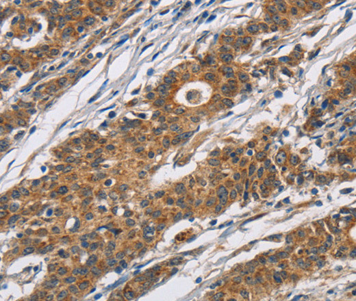 Immunohistochemistry of paraffin-embedded Human gasrtic cancer tissue using CYP21A2 Polyclonal Antibody at dilution 1:60