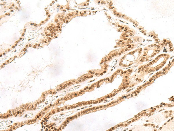 Immunohistochemistry of paraffin-embedded Human thyroid cancer tissue  using TOR1A Polyclonal Antibody at dilution of 1:30(?200)