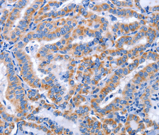 Immunohistochemistry of paraffin-embedded Human thyroid cancer using CCR6 Polyclonal Antibody at dilution of 1:50