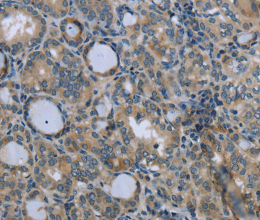 Immunohistochemistry of paraffin-embedded Human thyroid cancer tissue using EGFL8 Polyclonal Antibody at dilution 1:40