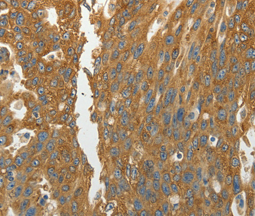 Immunohistochemistry of paraffin-embedded Human ovarian cancer using RPLP0 Polyclonal Antibody at dilution of 1:40